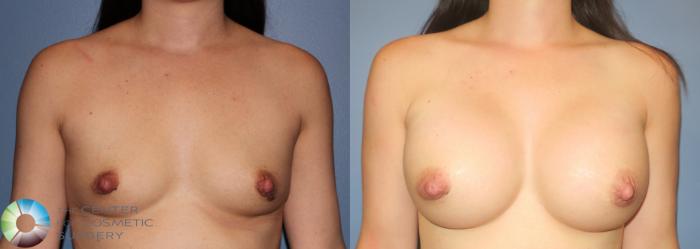 Before & After Breast Augmentation Case 925 View #1 in Denver, CO
