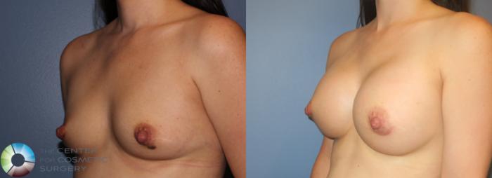 Before & After Breast Augmentation Case 925 View #2 in Denver, CO