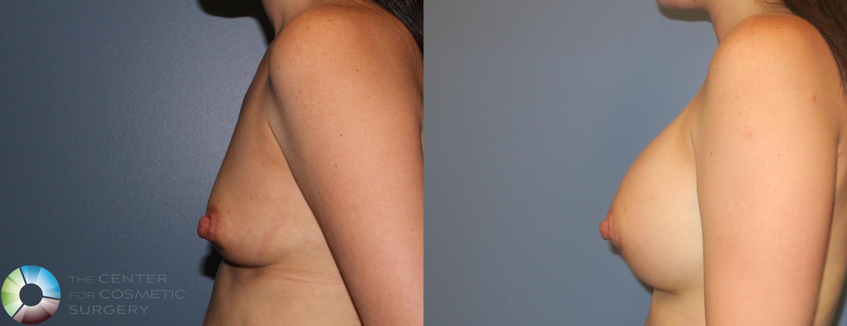 Before & After Breast Augmentation Case 925 View #3 in Denver and Colorado Springs, CO
