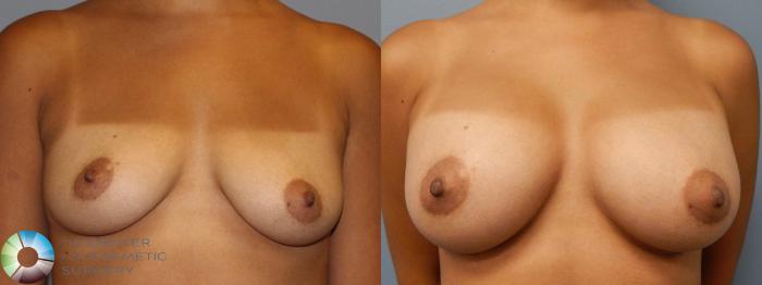 Before & After Breast Augmentation Case 926 View #1 in Denver and Colorado Springs, CO