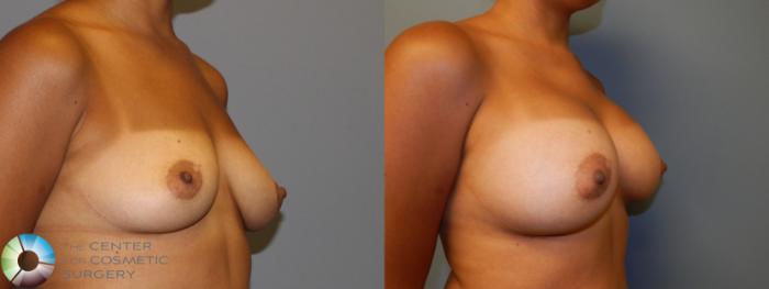 Before & After Breast Augmentation Case 926 View #2 in Denver and Colorado Springs, CO