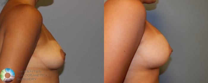 Before & After Breast Augmentation Case 926 View #3 in Denver and Colorado Springs, CO