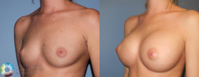 Before & After Breast Augmentation Case 929 View #1 in Denver and Colorado Springs, CO