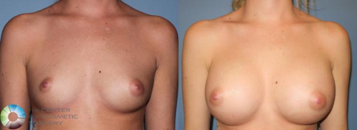 Before & After Breast Augmentation Case 929 View #2 in Denver and Colorado Springs, CO