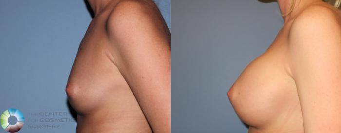 Before & After Breast Augmentation Case 929 View #3 in Denver and Colorado Springs, CO