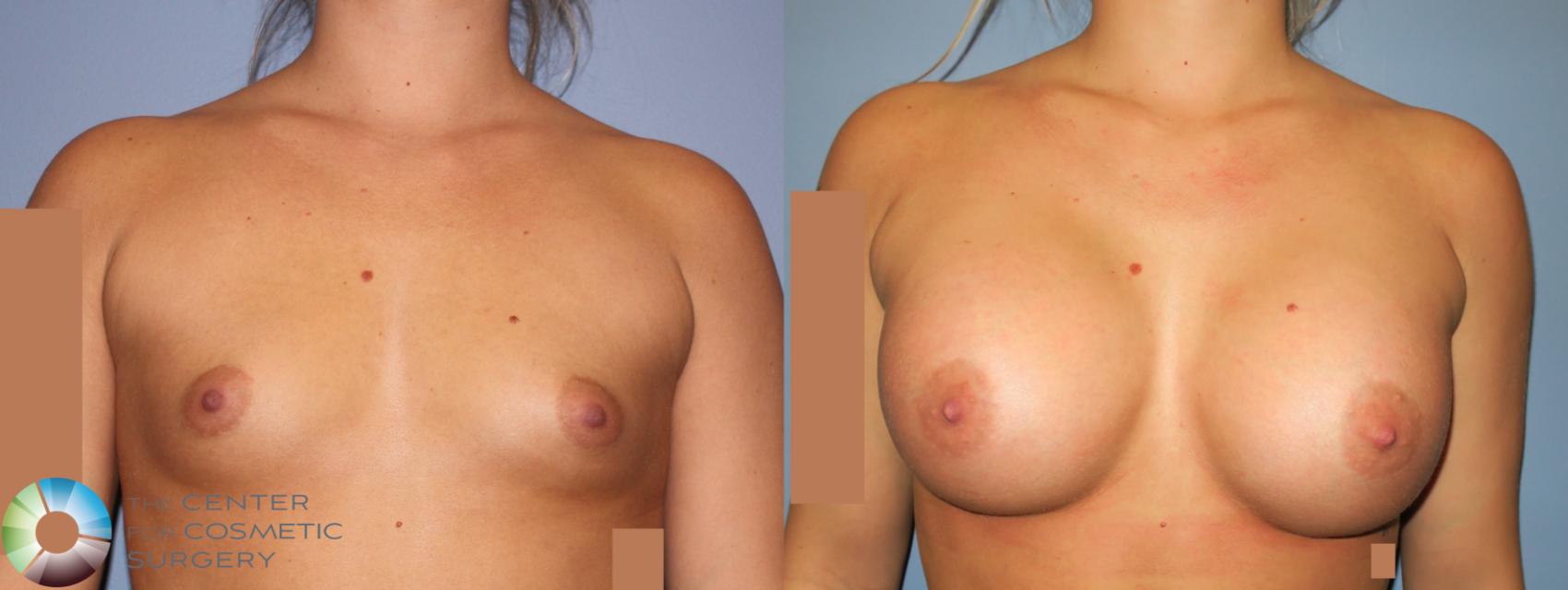 Before & After Breast Augmentation Case 930 View #1 in Denver, CO