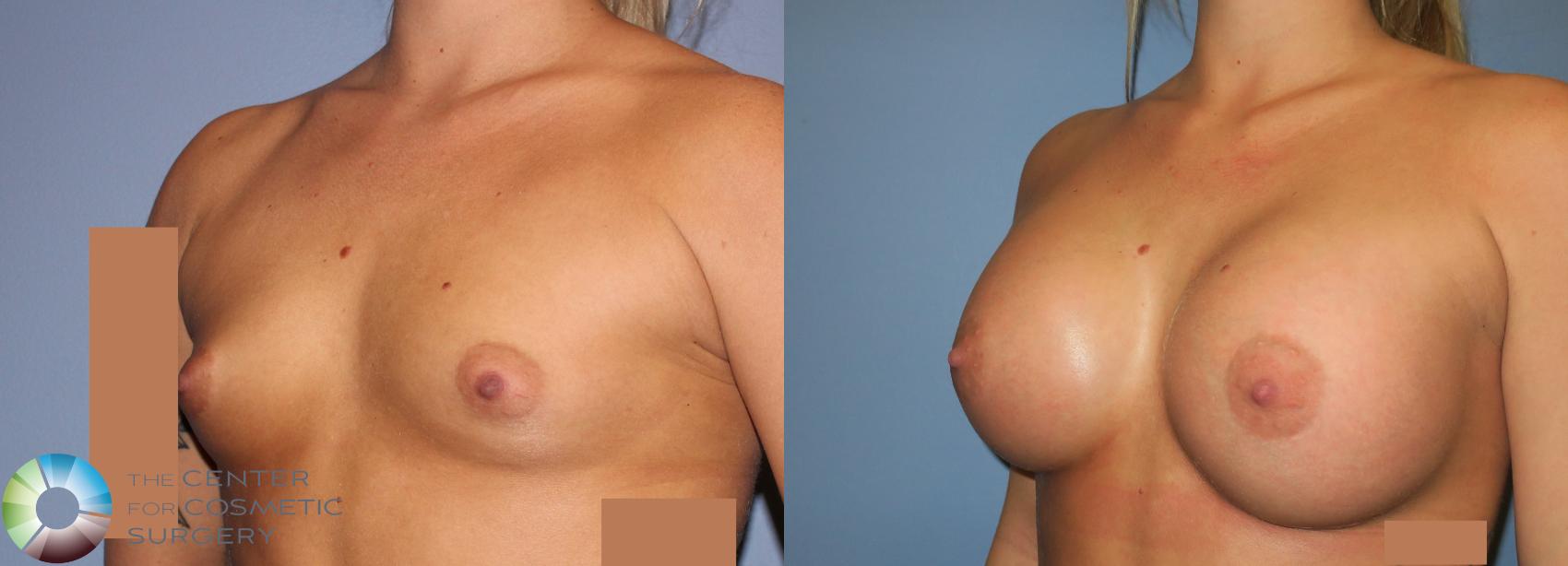 Before & After Breast Augmentation Case 930 View #2 in Denver and Colorado Springs, CO