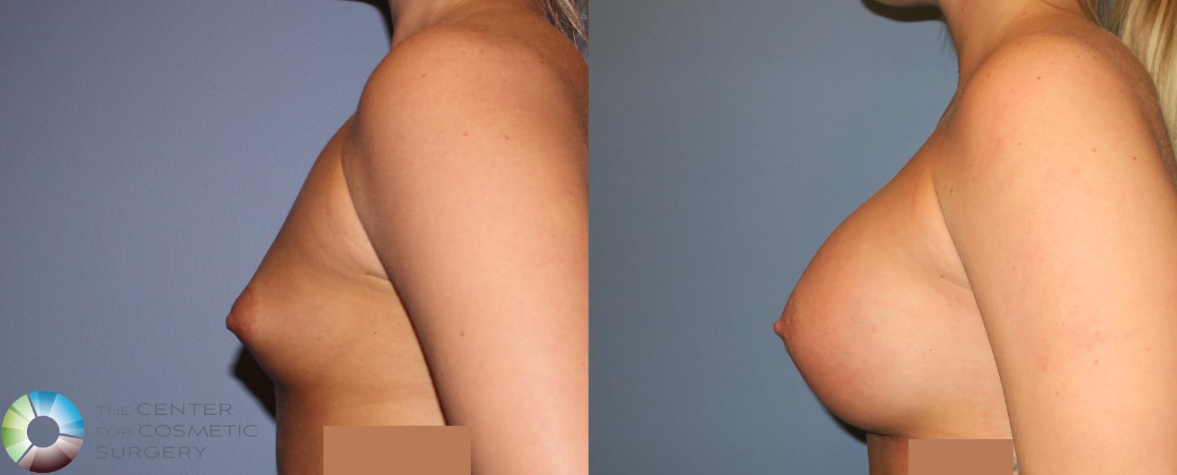 Before & After Breast Augmentation Case 930 View #3 in Denver and Colorado Springs, CO