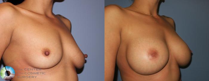 Before & After Breast Augmentation Case 931 View #2 View in Golden, CO