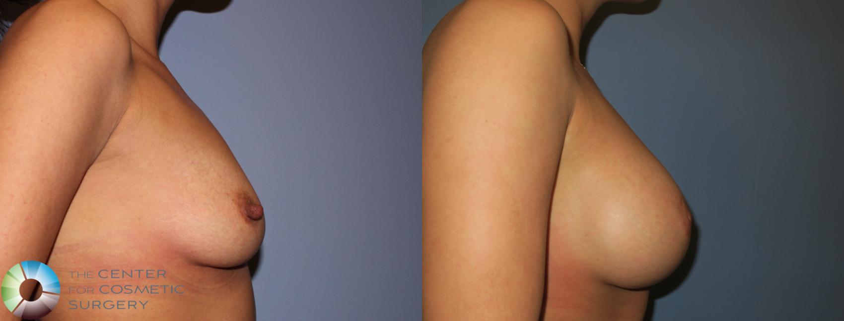 Before & After Nipple reduction Case 931 View #3 View in Denver & Golden, CO