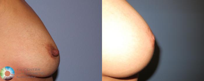 Before & After Breast Augmentation Case 931 View #4 View in Golden, CO