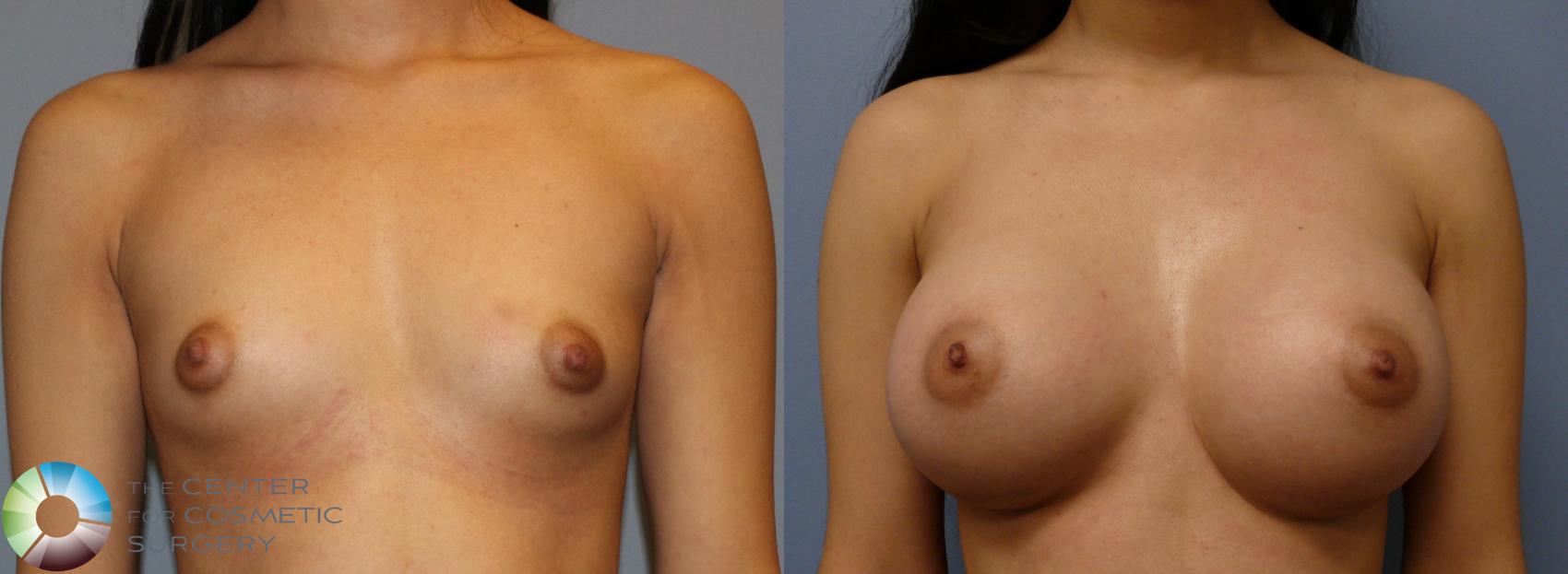 Before & After Breast Augmentation Case 932 View #1 in Denver and Colorado Springs, CO