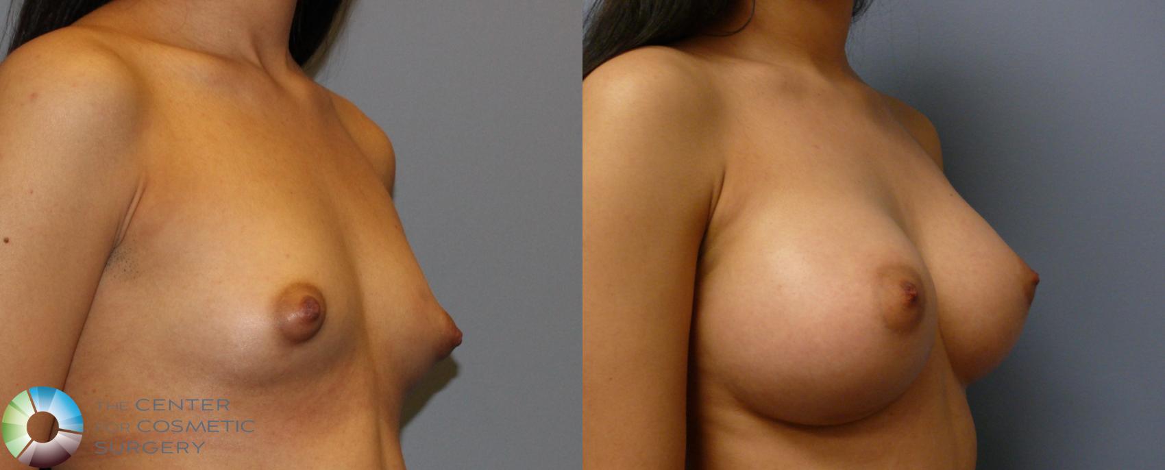 Before & After Breast Augmentation Case 932 View #2 View in Golden, CO