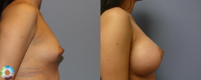 Before & After Breast Augmentation Case 932 View #3 View in Golden, CO