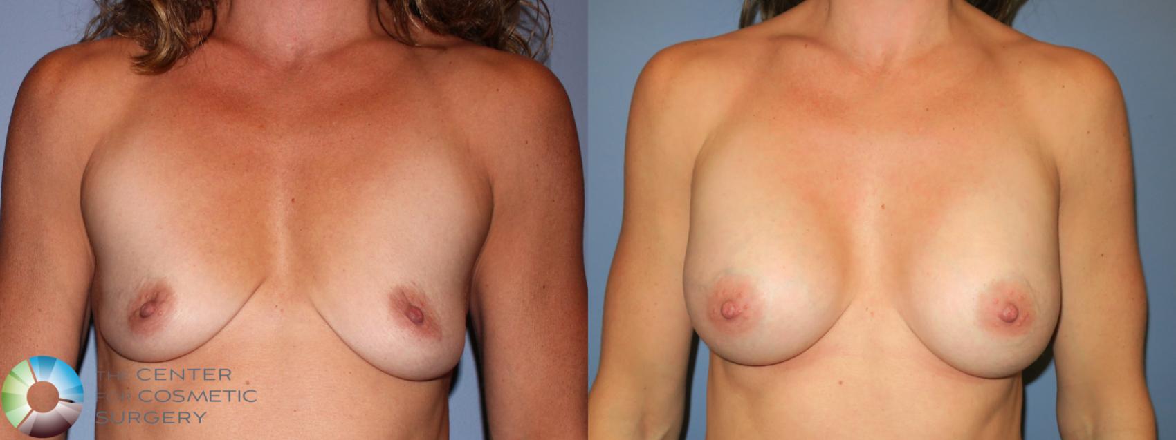 Before & After Breast Augmentation Case 933 View #1 in Denver and Colorado Springs, CO