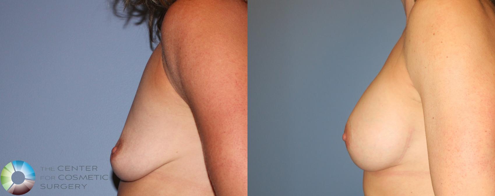 Before & After Breast Augmentation Case 933 View #3 View in Golden, CO