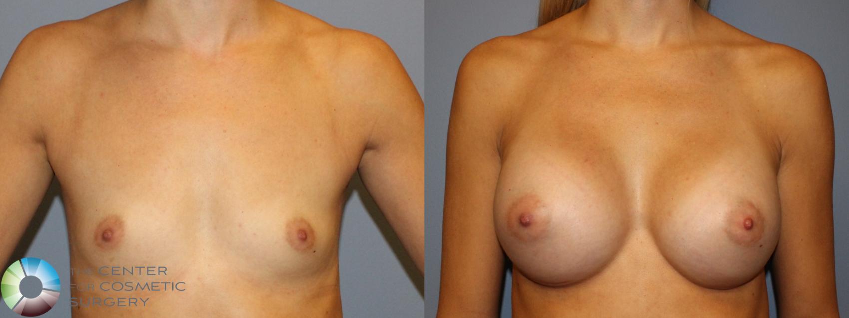 Before & After Breast Augmentation Case 934 View #1 in Denver and Colorado Springs, CO