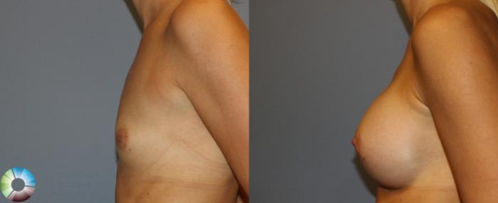 Before & After Breast Augmentation Case 934 View #3 View in Golden, CO