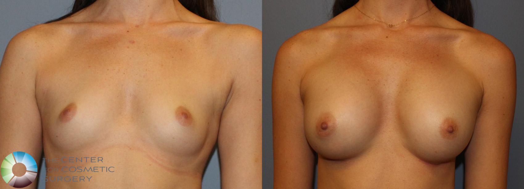 Before & After Breast Augmentation Case 935 View #1 View in Golden, CO