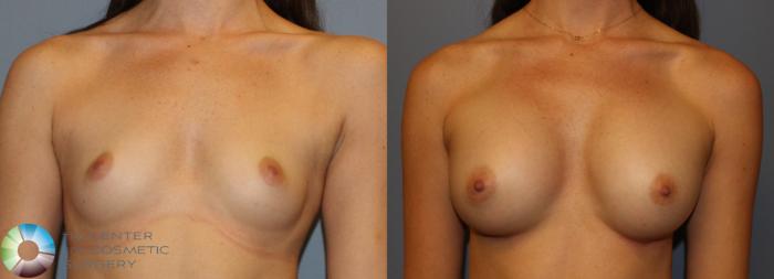 Before & After Breast Augmentation Case 935 View #1 in Denver and Colorado Springs, CO