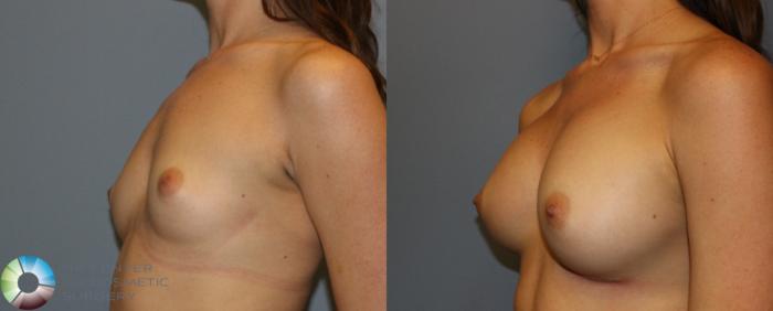 Before & After Breast Augmentation Case 935 View #2 in Denver and Colorado Springs, CO