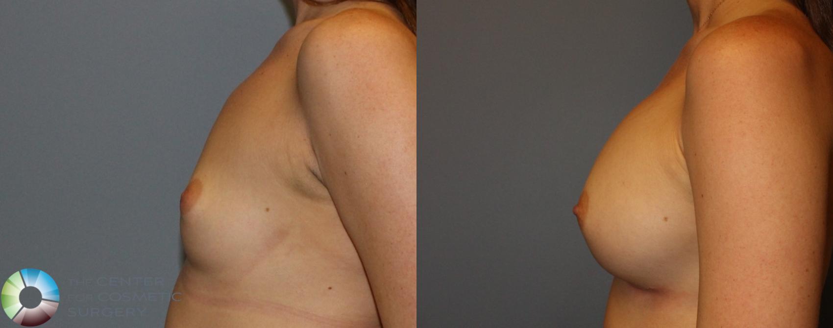 Before & After Breast Augmentation Case 935 View #3 View in Golden, CO