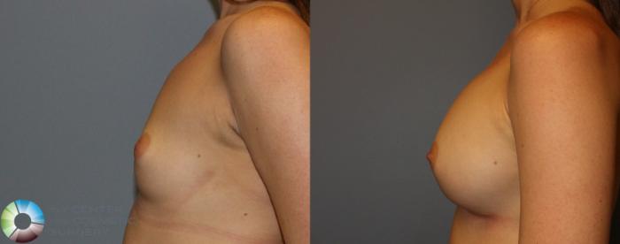 Before & After Breast Augmentation Case 935 View #3 in Denver and Colorado Springs, CO