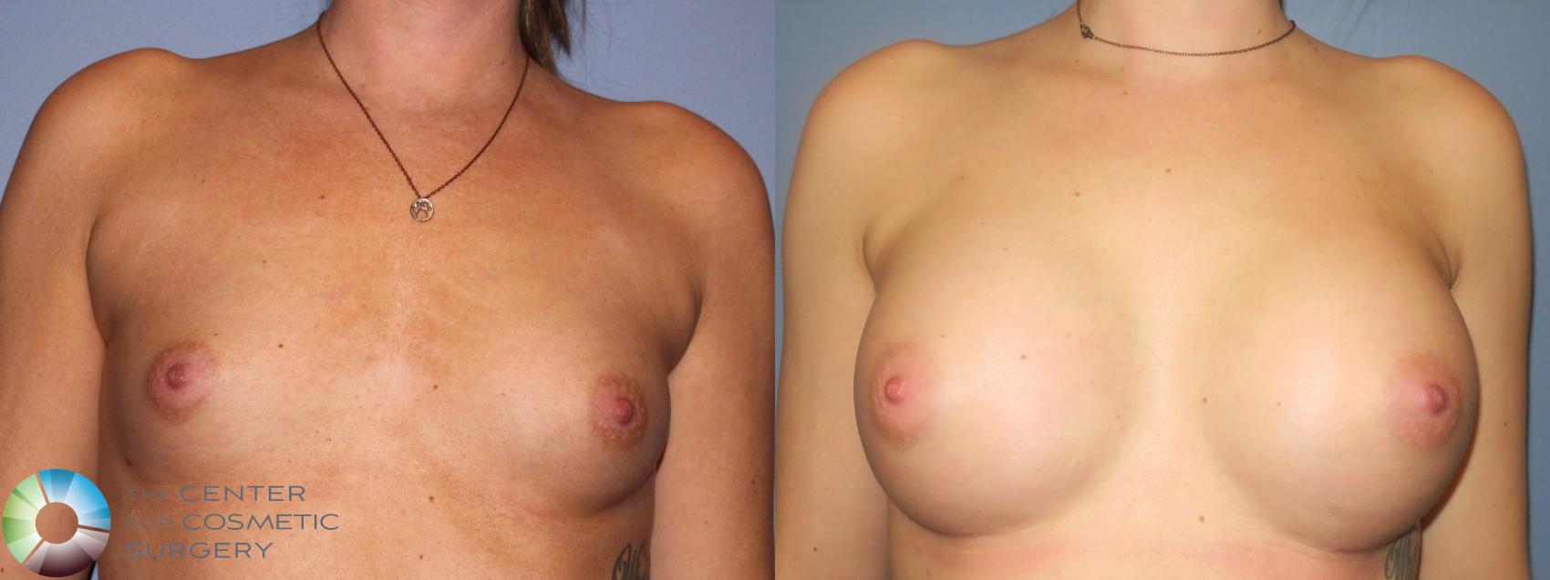Before & After Breast Augmentation Case 936 Front View in Golden, CO