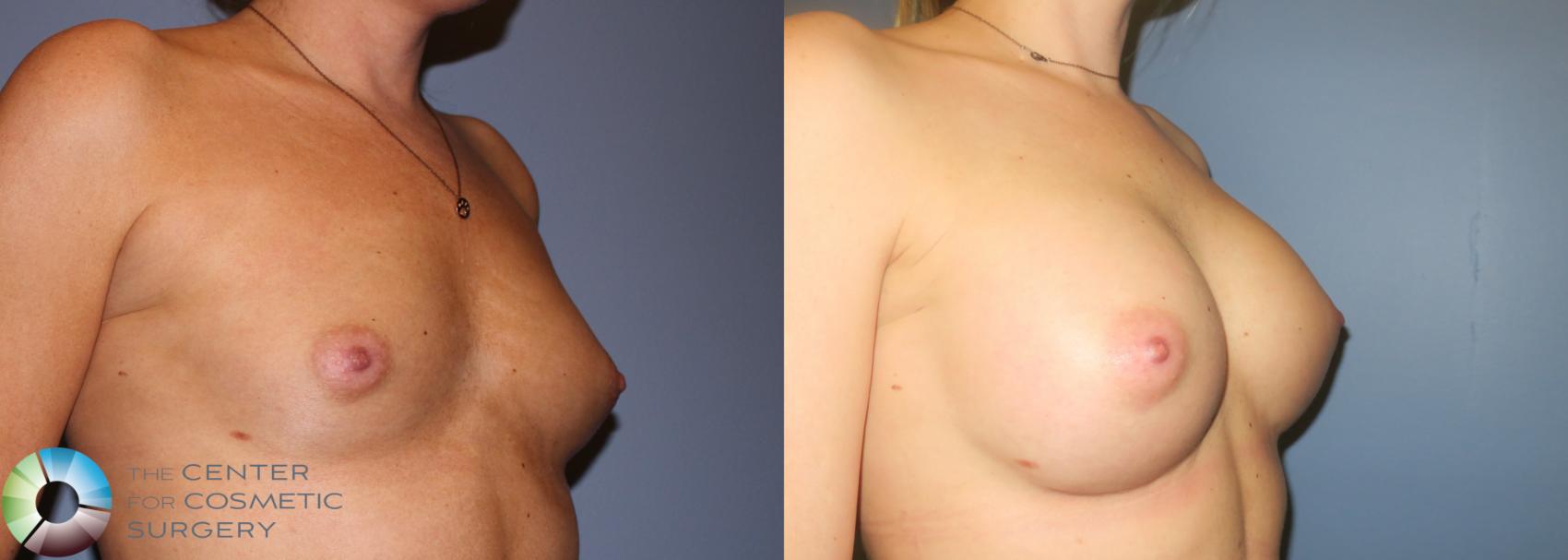 Before & After Breast Augmentation Case 936 View #2 in Denver and Colorado Springs, CO