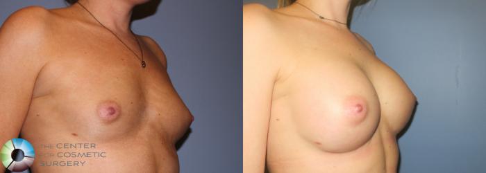 Before & After Breast Augmentation Case 936 View #2 View in Golden, CO