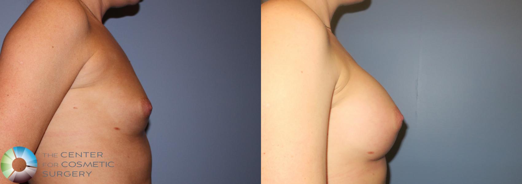 Before & After Breast Augmentation Case 936 View #3 in Denver and Colorado Springs, CO