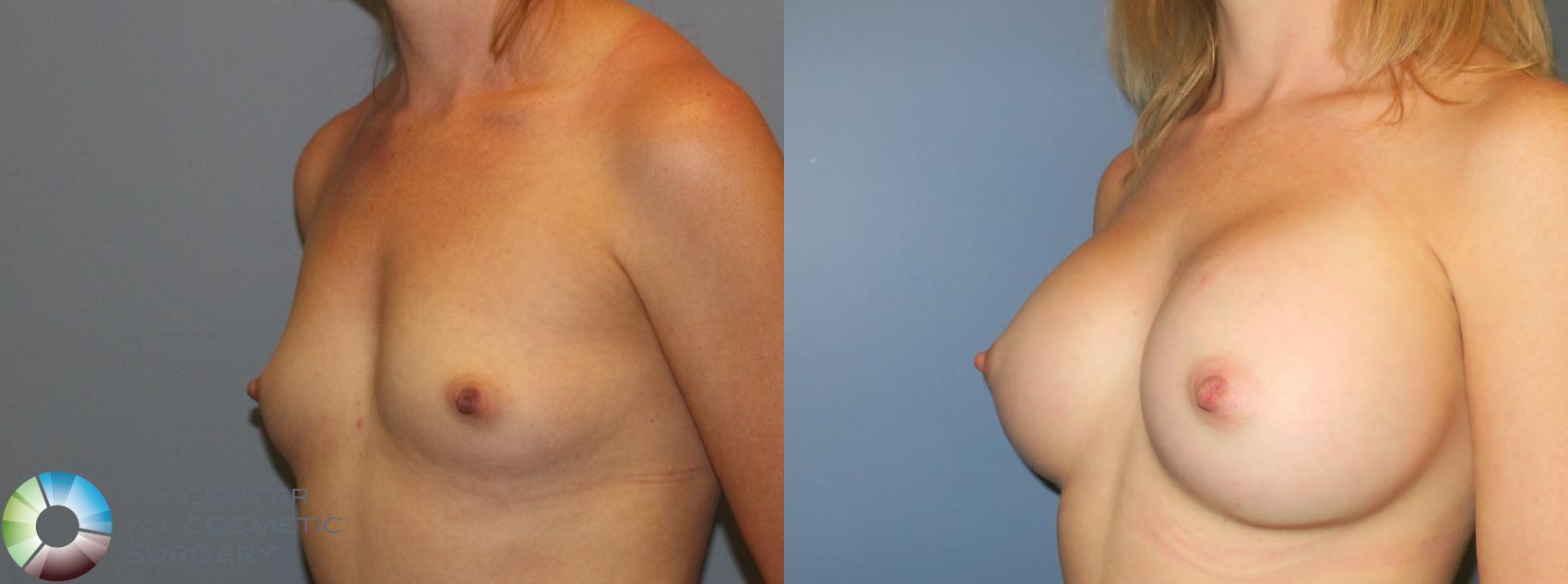 Before & After Breast Augmentation Case 937 View #1 in Denver and Colorado Springs, CO