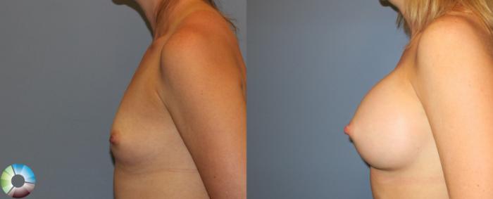 Before & After Breast Augmentation Case 937 View #2 View in Golden, CO