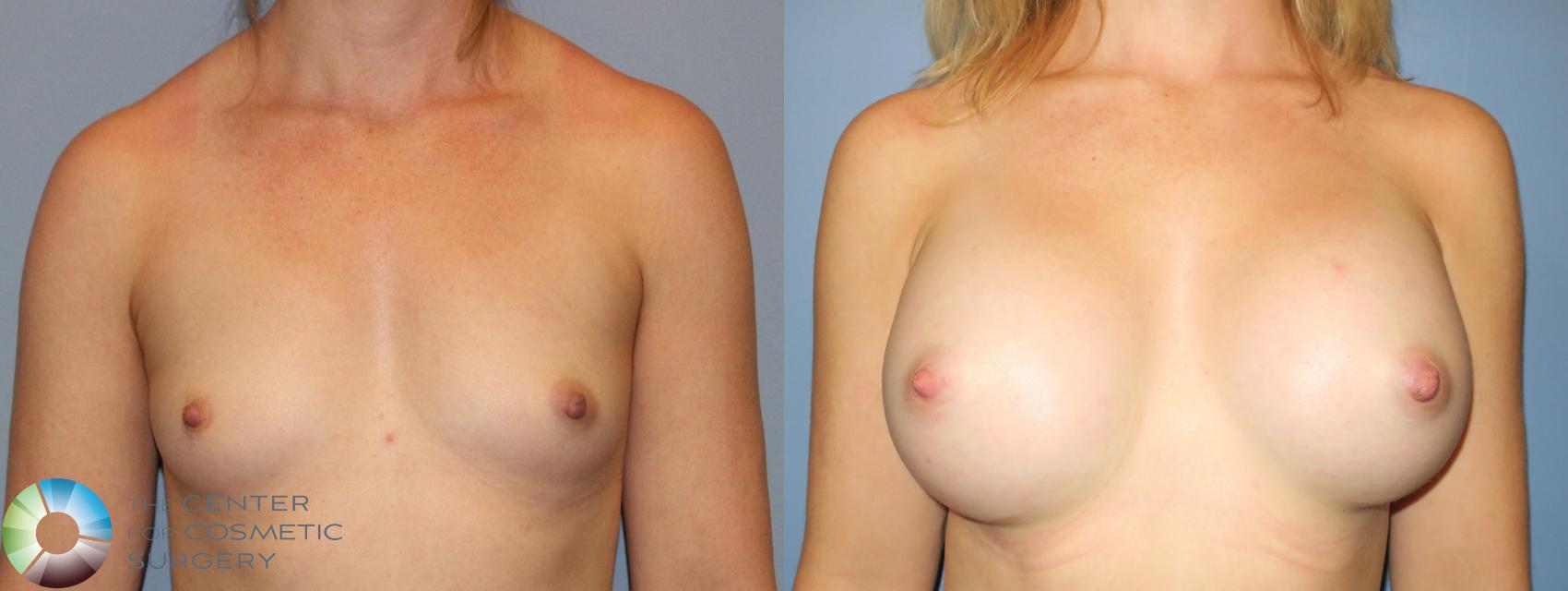 Before & After Breast Augmentation Case 937 View #3 View in Golden, CO