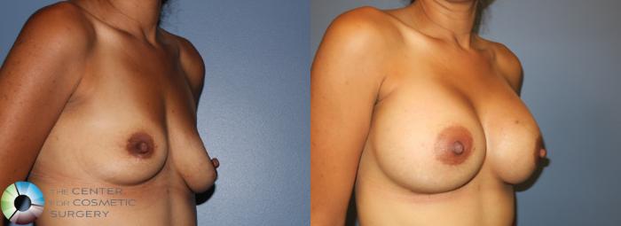 Before & After Breast Augmentation Case 938 View #1 in Denver, CO
