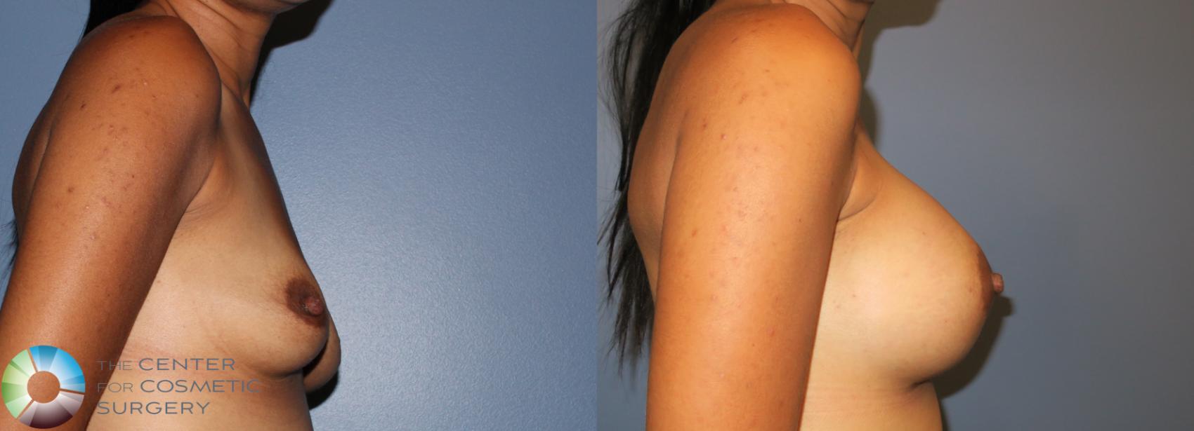 Before & After Breast Augmentation Case 938 View #2 in Denver and Colorado Springs, CO