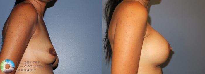 Before & After Breast Augmentation Case 938 View #2 in Denver, CO