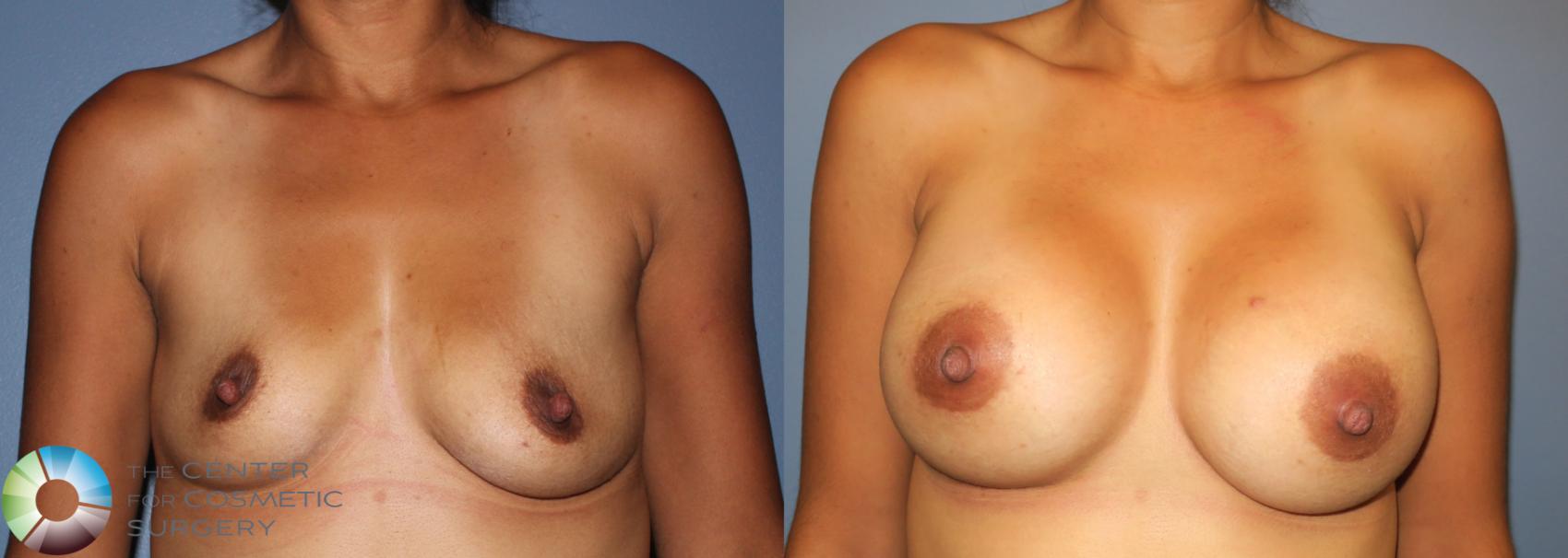 Before & After Breast Augmentation Case 938 View #3 in Denver and Colorado Springs, CO