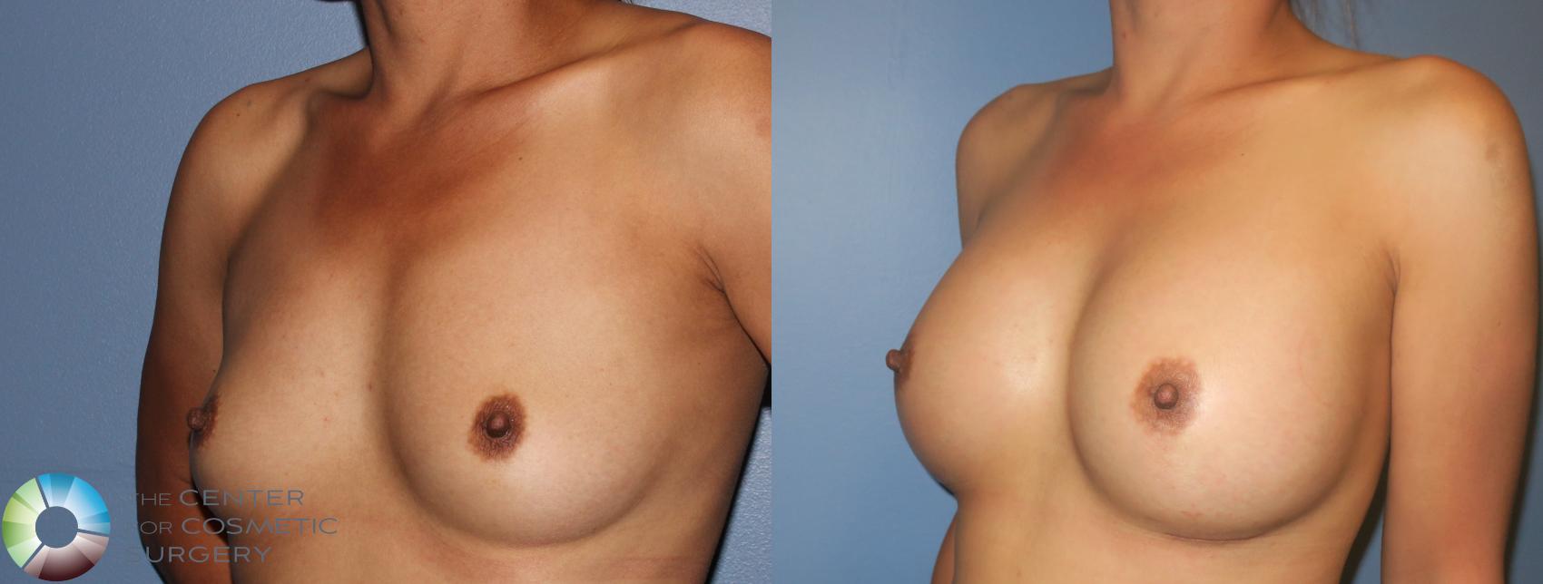 Before & After Breast Augmentation Case 939 View #1 in Denver, CO