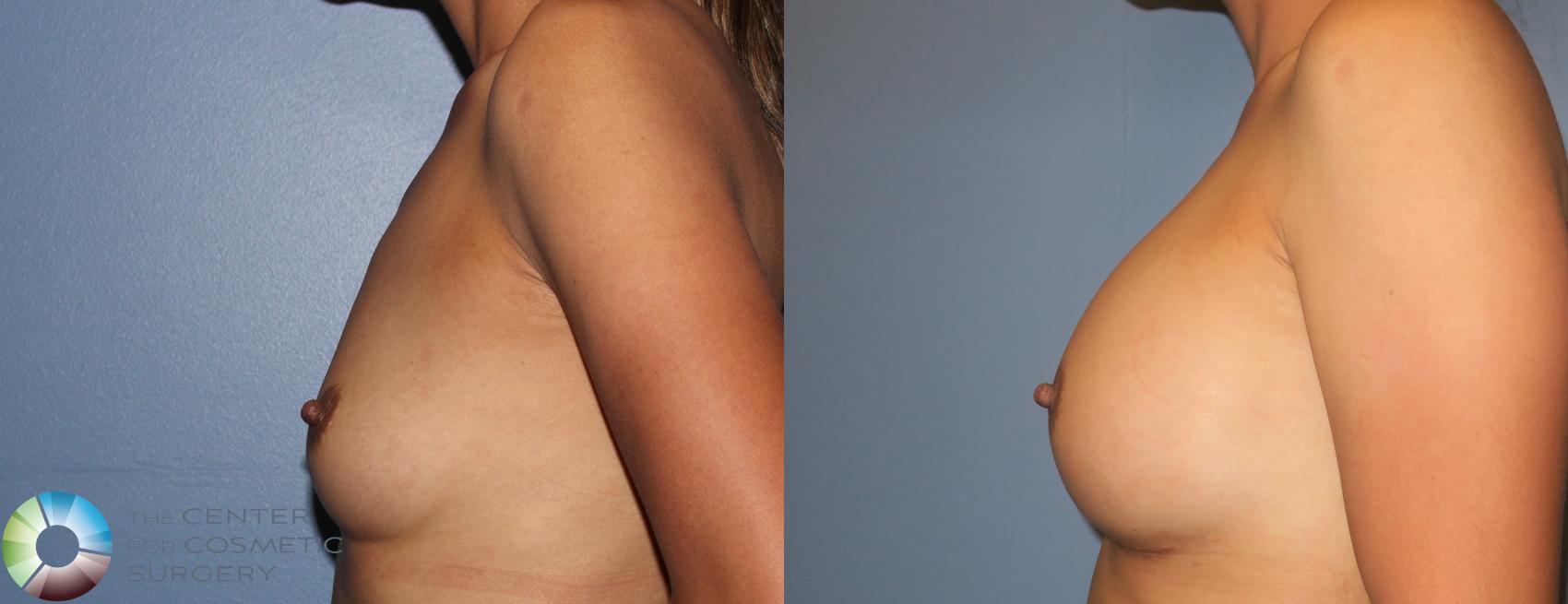 Before & After Breast Augmentation Case 939 View #2 View in Golden, CO