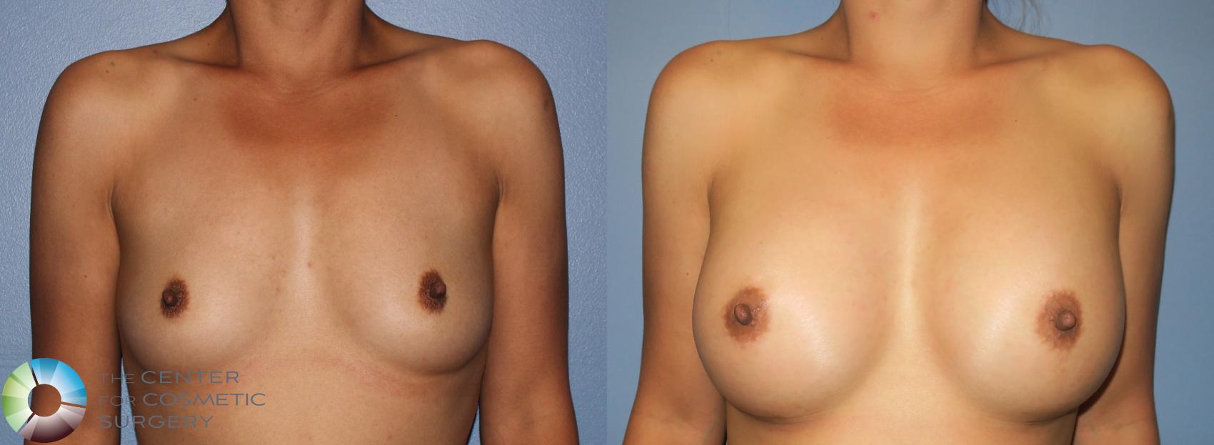 Before & After Breast Augmentation Case 939 View #3 View in Golden, CO