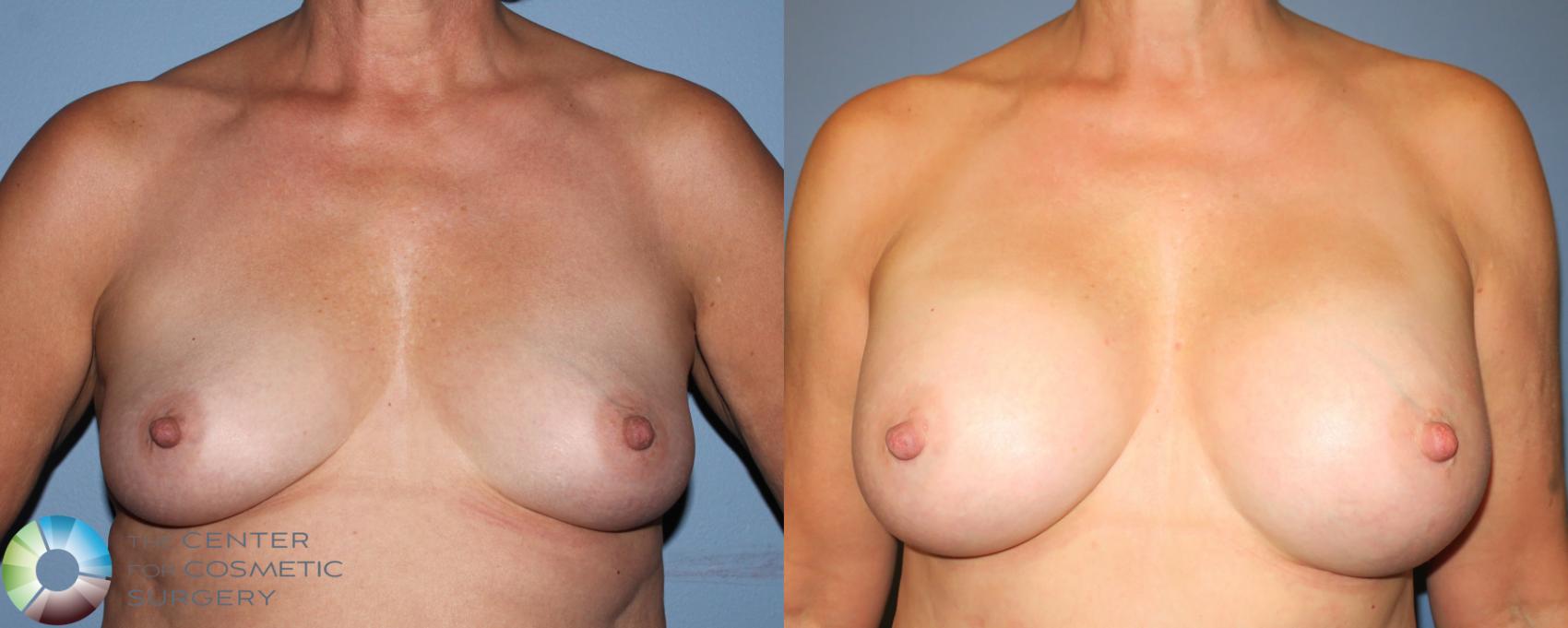 Before & After Breast Augmentation Case 940 View #1 in Denver and Colorado Springs, CO