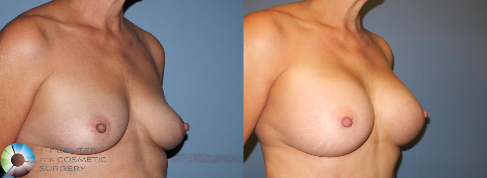 Before & After Breast Augmentation Case 940 View #2 View in Golden, CO