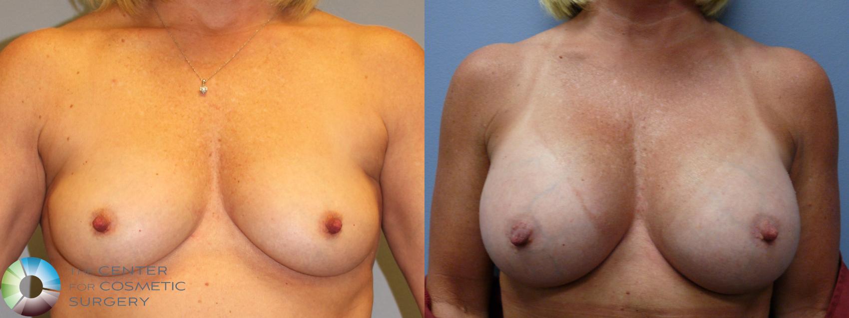 Before & After Breast Augmentation Case 963 View #1 in Denver and Colorado Springs, CO