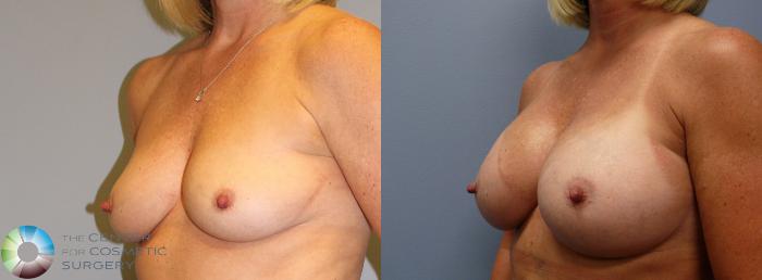 Before & After Breast Augmentation Case 963 View #2 in Denver and Colorado Springs, CO