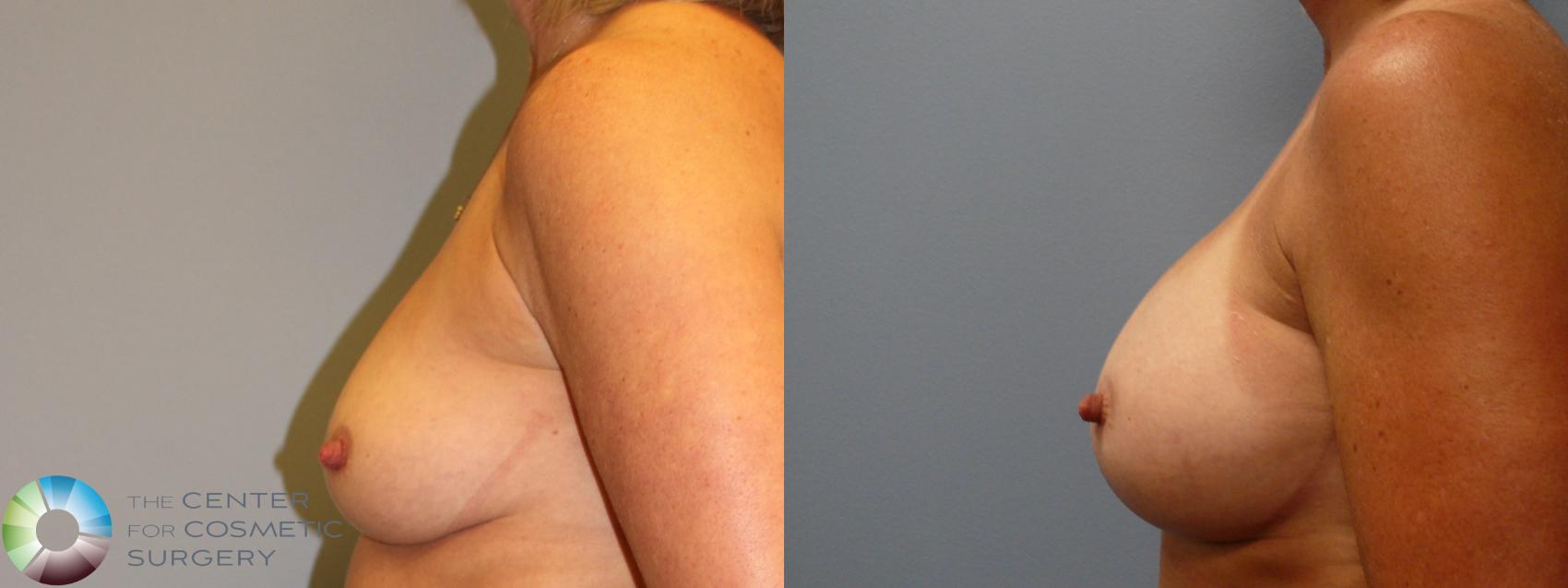 Before & After Breast Augmentation Case 963 View #3 in Denver and Colorado Springs, CO