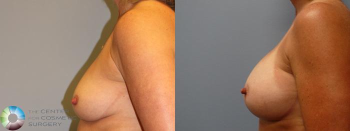 Before & After Breast Augmentation Case 963 View #3 in Denver and Colorado Springs, CO