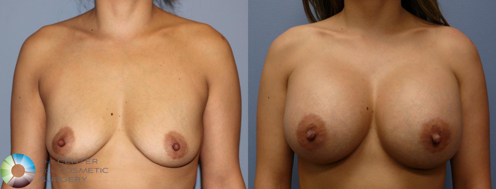 Before & After Breast Augmentation Case 964 View #1 View in Golden, CO