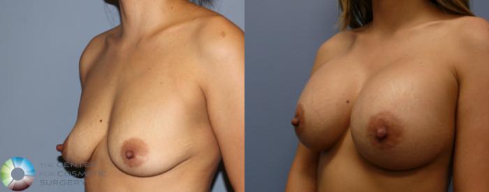 Before & After Breast Augmentation Case 964 View #2 View in Golden, CO