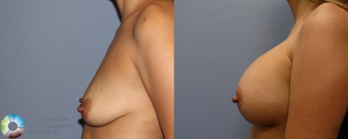 Before & After Breast Augmentation Case 964 View #3 View in Golden, CO